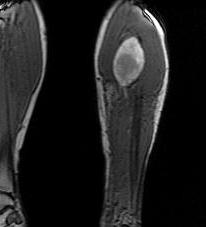 Neurofibrosarcoma NF Leg MRI Coronal T2